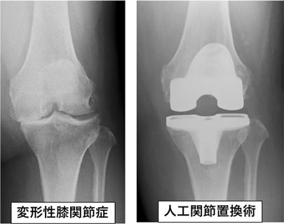 変形性膝関節症/人工関節置換術
