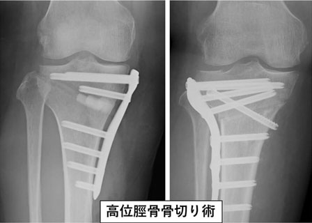 高位脛骨骨切り術