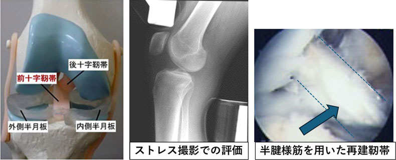 膝前十字靱帯損傷